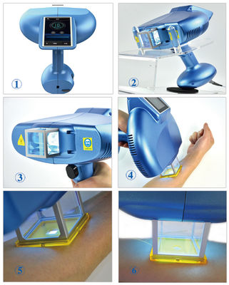 Homeuse 308NM Excimer System Excimer Laser Vitiligo FDA CE Psoriasis