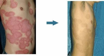 Plastic Ultraviolet Psoriasis Lamps UVB Phototherapy Instrument 50Hz